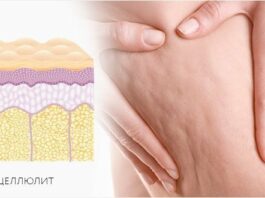 КАК ПОБЕДИТЬ ЦЕЛЛЮЛИТ