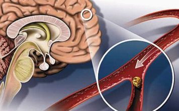 Как очистить сосуды головного мозга. Мощные рецепты народной медицины!