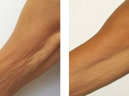 Морщинистая шея, дряблые руки и рыхлые бедра в прошлом! Это средство огорчит пластических хирургов