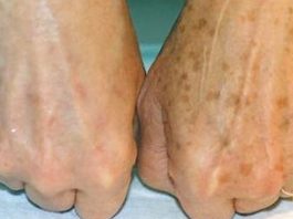 Известный дерматолог говорит: избавьтесь от коричневых пятен на лице с помощью этого средства!