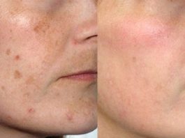 Эта маска удалит пятна с лица всего за 3 ночи! 4 рецепта!