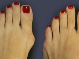 народные способы быстро уберут косточку на ноге