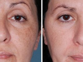 Женщина Протирает Этим Средством Лицо И Выглядит Словно Ей Не 44, А 25!