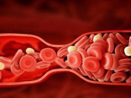 Причины, симптомы и 5 природных методов лечения тромбоза глубоких вен