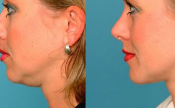 Легкий способ устранить двойной подборок и морщины за 5 минут в день