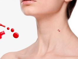 лак для удаления папиллом