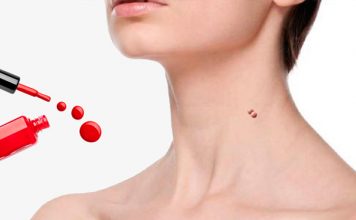 лак для удаления папиллом