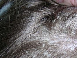 5 ранних предупреждающих признаков проблем кожи головы, которые никогда нельзя игнорировать