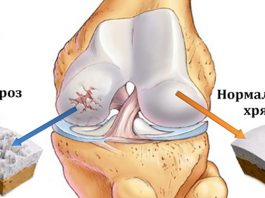 Врач-натуропат для восстановления хрящей коленей, суставов и укрепления костей посоветовал замечательное средство!
