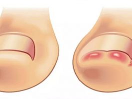 Лечим вросший ноготь на ноге: 11 мощных домашних рецептов