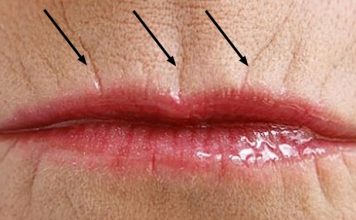 Невероятно! Этот способ помог избавиться от морщин над губой