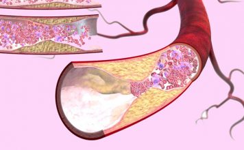 Атеросклероз: 4 рецепта для здоровья сосудов