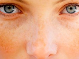 Домашний лосьон, отбеливающий веснушки и темные пятна