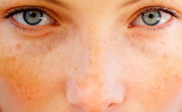 Домашний лосьон, отбеливающий веснушки и темные пятна