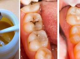 Маска для зубов, которая лишит стоматологов работы! 4 натуральных компонента