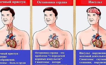 Разница между инфарктом и инсультом 