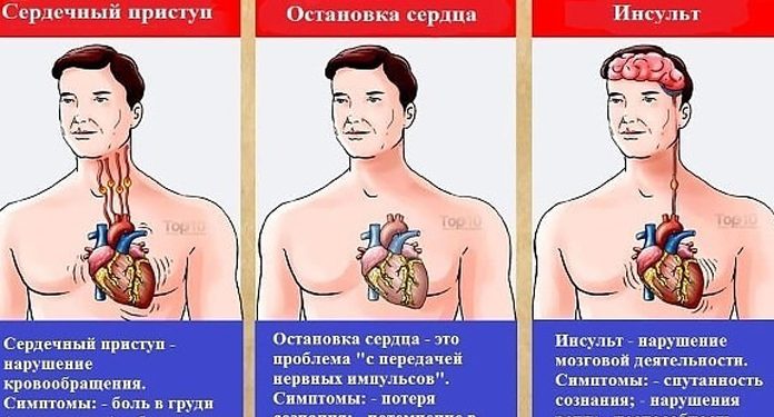 Разница между инфарктом и инсультом 