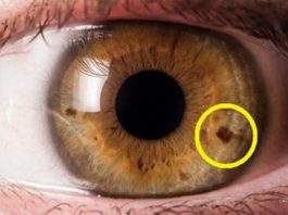 пятнышко на радужке