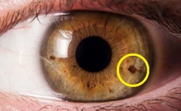 пятнышко на радужке