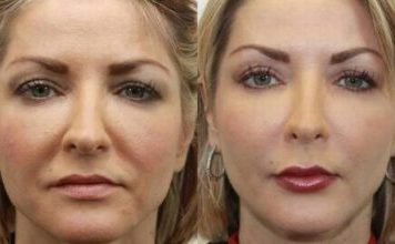 Даже очень дряблая кожа лица после этой процедуры подтянется! Делайте это 1 раз в неделю