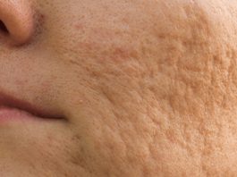 7 действующих способов устранения шрамов от акне