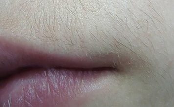 Как избавиться от женских усиков