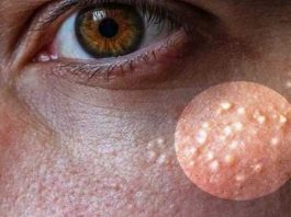 Млечные пятна — 7 натуральных средств для избавления млечные пятна