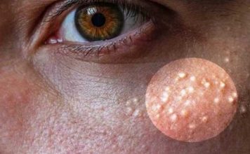 млечные пятна