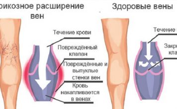 Как лечить варикоз в домашних
