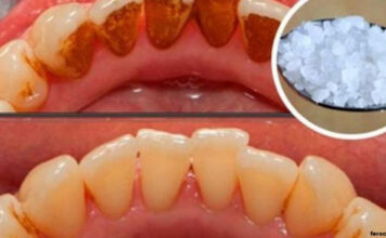 Вот как избавиться от зубного камня без помощи стоматолога