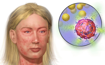 Отек Квинке: алгоритм первой помощи