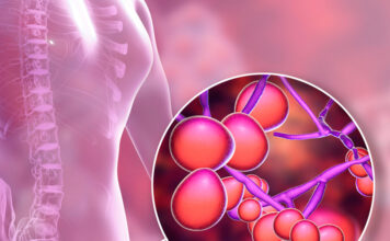 Как избавиться от кандидоза